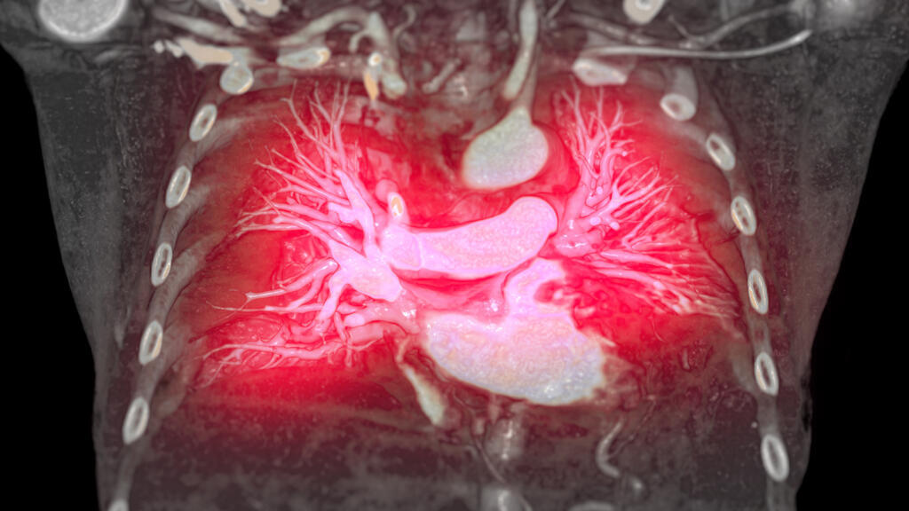 Hypertension artérielle pulmonaire: avancée importante dans la prise en charge de cette maladie rare