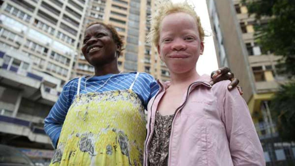 Une jeune fille albinos avec sa maman à Kinshasa. En RDC, on estime à plus de 7 millions le nombre de personnes albinos, qui font souvent l’objet de discriminations.