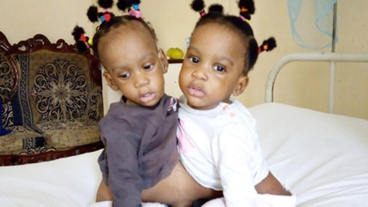 Once conjoined, Cameroonian sisters spend first Christmas as regular