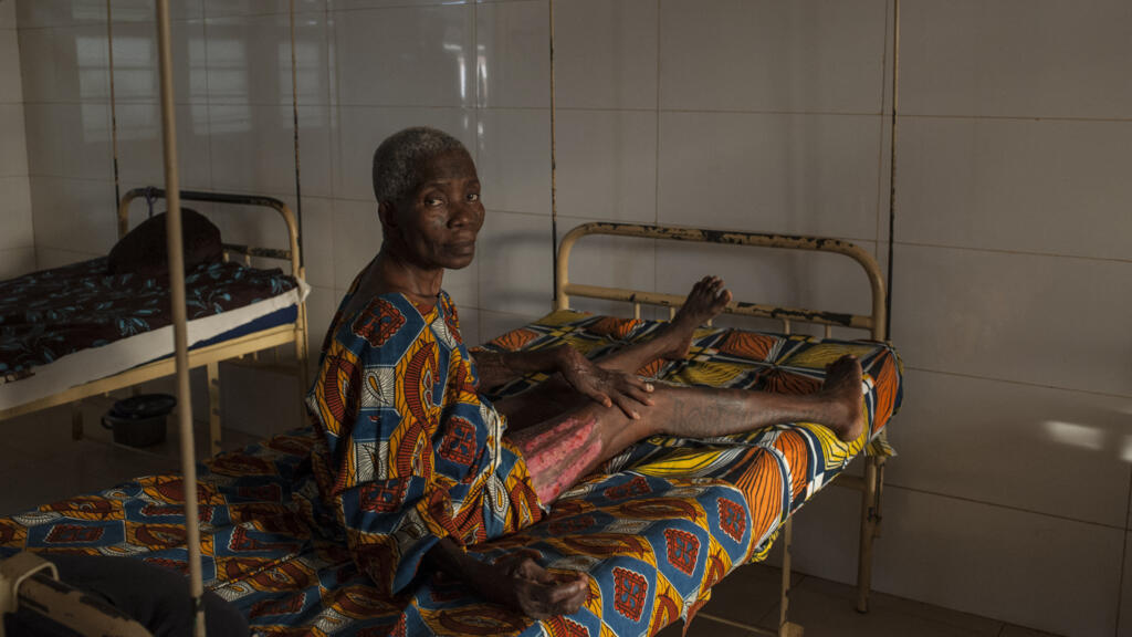 Une femme âgée qui souffrait d'ulcères de Buruli montre les cicatrices d'une opération de greffe de peau qu'elle a reçue à la Fondation Follereau pour le dépistage de la lèpre à Pobe, le 12 janvier 2017. Au Bénin, pays d'Afrique de l'Ouest, entre 150 et 200 nouveaux cas de lèpre sont enregistrés chaque année, dont 10 % d'enfants.